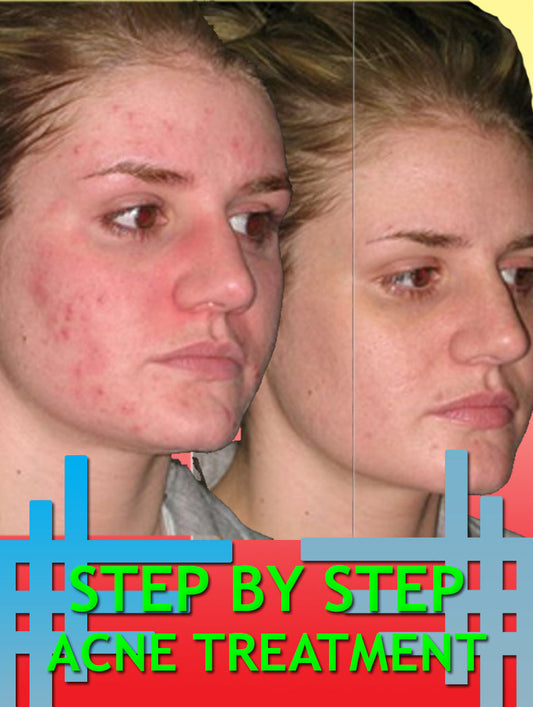 Step By Step Acne Treatment eBook